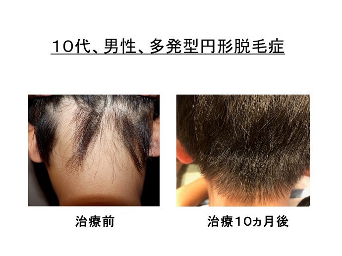 円形脱毛症　病院